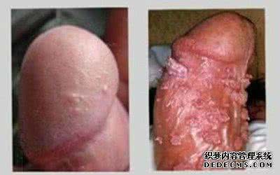 中药治疗肥胖症方子 治疗湿疣的中药方子 有图有方子,常见皮肤病的中药治疗