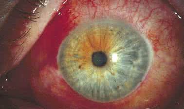 细菌性结膜炎的症状 细菌性结膜炎 细菌性结膜炎的病因