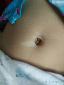 肚子上有胎记代表什么 肚子上有胎记 肚子上长胎记代表什么?