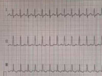 阵发性室上性心动过速 阵发性室性心动过速 患上它应该如何治疗