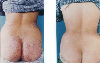 紫癫性肾炎能治好吗 紫癫性肾炎 它的主要表现有哪些