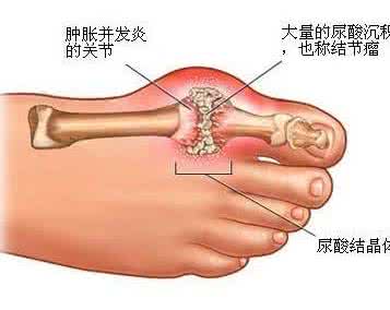 中医治疗痛风 中医治疗痛风 痛风怎么办 中医穴位按摩辅助治疗痛风