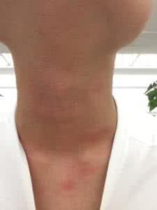 海鲜过敏怎么治 海鲜过敏 如何防治海鲜过敏