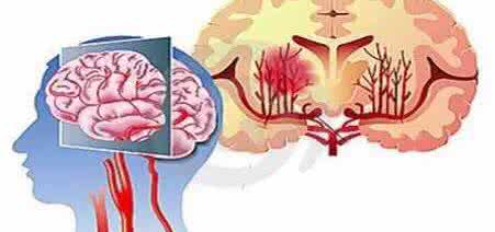 脑出血和脑梗塞区别 为什么有些人一辈子不得脑梗和脑出血？他们不过只做了六件事