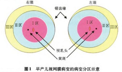 早产儿视网膜病变筛查 我国发布早产儿视网膜病变筛查指南