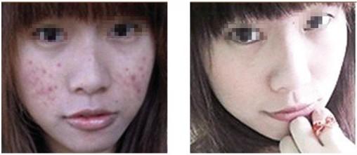 激光祛痘效果怎么样 激光祛痘 激光祛痘效果怎么样