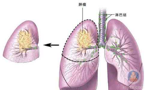 小细胞肺癌10年生存期 小细胞肺癌能活多久 小细胞肺癌生存期