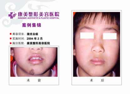 激光去痣后的护理 白醋去痣的正确方法 激光去痣后正确的护理方法