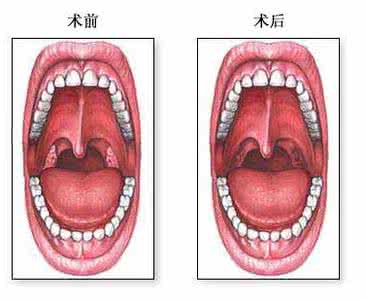 儿童扁桃体化脓偏方 儿童扁桃体发炎的偏方