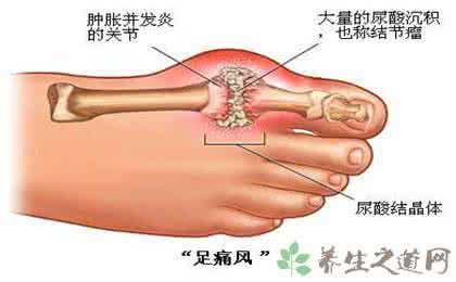 痛风的简单治疗方法 治疗痛风的简单方法*