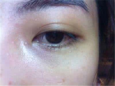 眼部脂肪粒怎么去除 【眼部脂肪粒怎么去除】教你如何去除眼部脂肪粒_眼部脂肪粒怎么去除