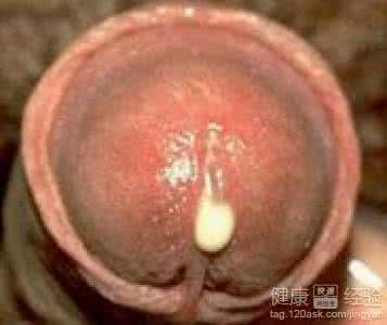 淋病的早期症状 淋病的早期症状 淋病为什么越来越多 前期症状有什么？
