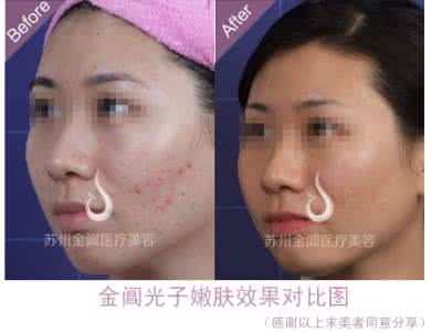 做光子嫩肤一次多少钱 光子嫩肤一次多少钱 光子嫩肤做一次多少钱