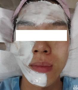 激光祛痘印痘疤 激光去痘疤 激光祛痘疤