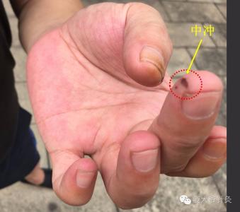 傻大爷针灸 傻大爷谈针灸20：掐中冲心脏急救法