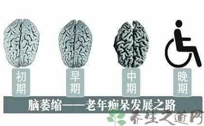 脑萎缩最佳治疗方法 疾病预防  脑萎缩最佳治疗方法 脑萎缩的四大症状