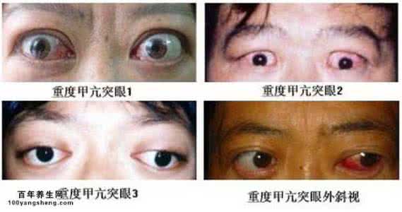 眼球突出怎么治疗 眼球突出怎么办 怎么治疗眼球突出
