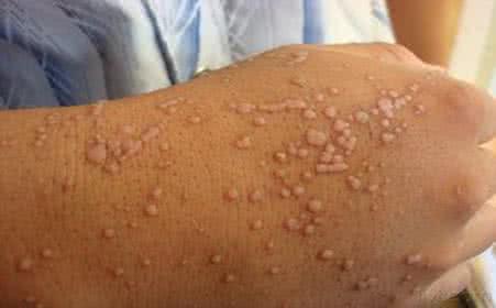 扁平疣患者的饮食 扁平疣的症状有哪些 扁平疣患者会有哪些症状