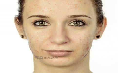 女人内分泌失调长痘痘 内分泌失调为什么会长痘？该如何处理