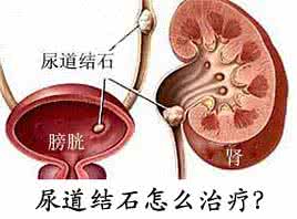 尿路结石怎么治疗 尿路结石 尿路结石怎么治疗