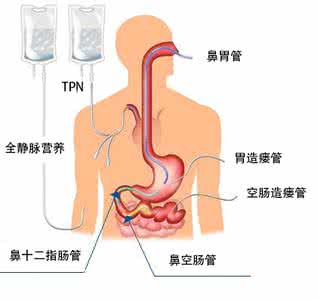 急性胰腺炎肠内营养 胰腺炎营养支持方式 胰腺疾病的治疗