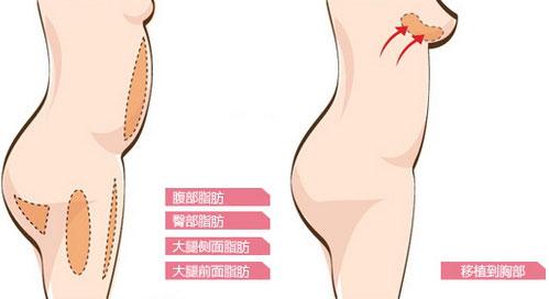 抽脂隆胸好吗 抽脂隆胸 抽脂隆胸，好放心