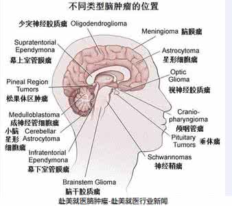 脑肿瘤的早期症状 脑肿瘤的类型以及脑肿瘤的病因各是什么？