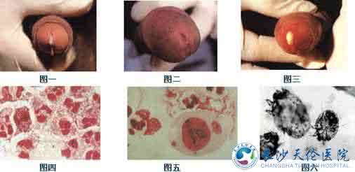 淋病无症状后治疗方法 淋病的早期症状 淋病的治疗方法
