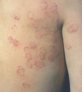 治疗皮肤癣的偏方 怎样治疗牛的皮肤癣效果好？