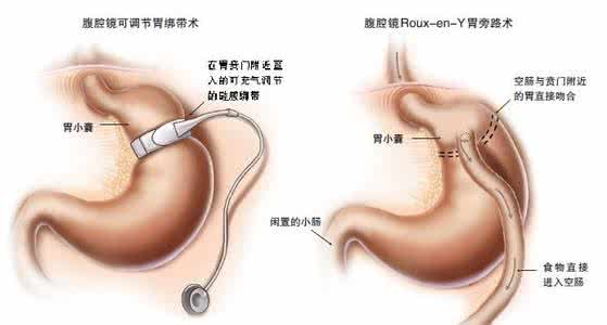 胃癌早期手术后复发率 胃癌早期手术后复发率 早期胃癌手术治疗效果好吗