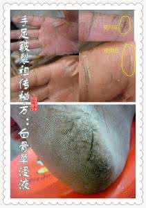 草木犀流浸液片 图文:手足皲裂祖传秘方“白骨草浸液”