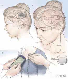 肌张力障碍能治好吗 小脑肌张力障碍能治吗？