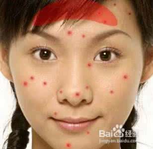 痘痘临床症状 痘痘临床症状 痘痘的临床症状都有哪些