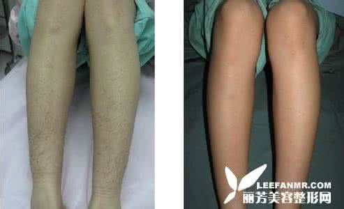 激光脱毛有没有副作用 脱毛副作用 脱毛后有没有副作用