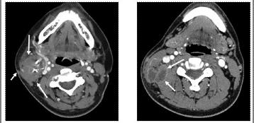 颈部淋巴结肿大 颈部肿大淋巴结的CT分析