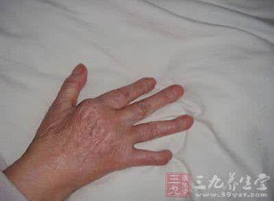 化脓性关节炎 化脓性关节炎 化脓性关节炎怎么回事