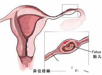 宫外孕病因 宫外孕病因 宫外孕的病因病理认知