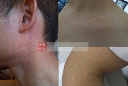 皮肤长汗斑 皮肤知识：牢记6大点预防汗斑复发