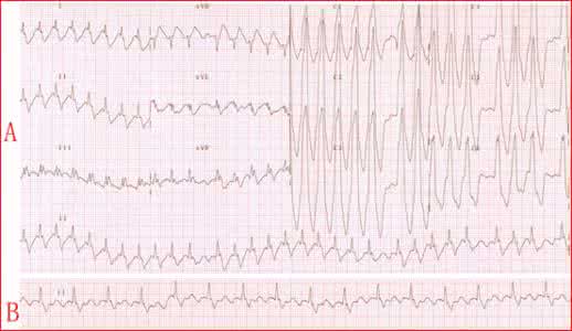 心律失常的诊断与治疗 心律失常急症的诊断和治疗