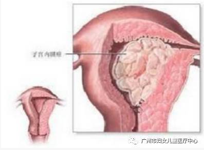 子宫出血能做宫腔镜吗 阴道超声与宫腔镜对绝经后异常子宫出血的诊断价值