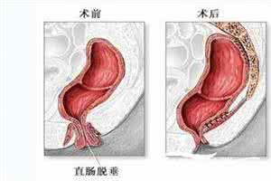脱肛的症状与治疗 脱肛的原因 脱肛的症状与治疗