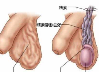 阴囊水肿 中医望二阴之阴囊水肿
