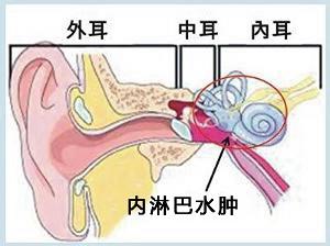 治美尼尔综合症的偏方 美尼尔综合症《眩晕症》