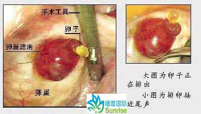 试管婴儿监测卵泡个数 试管婴儿吃什么长卵泡 试管婴儿对卵泡有什么要求吗？