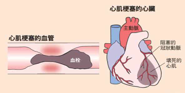 学会这一招 心梗无老少 学会这一招可救命