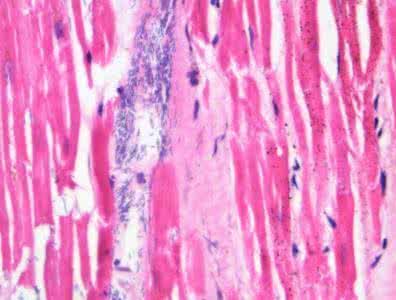 白色念珠菌怎么根治 白色念珠菌感染 如何预防白色念珠菌感染