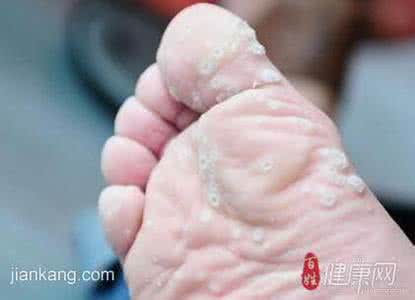 脚上长鸡眼是什么原因 脚上长鸡眼怎么办 是什么原因呢