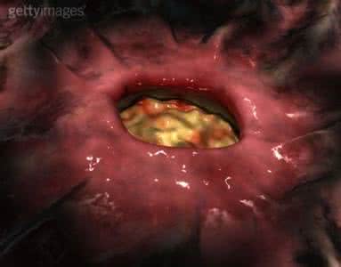 跑步把癌细胞跑没了 癌细胞其实没那么可怕 ！