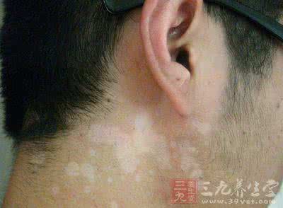 汗斑与白斑的区别 汗斑会传染吗？什么是汗斑？