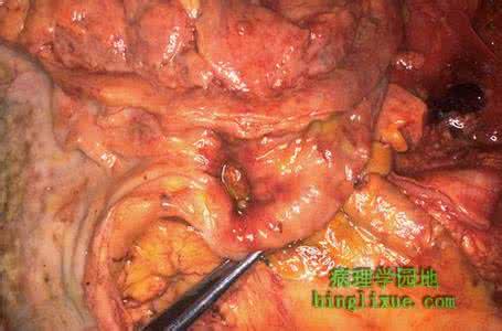十二指肠溃疡穿孔症状 十二指肠溃疡急性穿孔 十二指肠溃疡急性穿孔 如何治疗这种症状